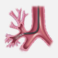 Bronchial Thermoplasty - Image courtesy of Boston Scientific