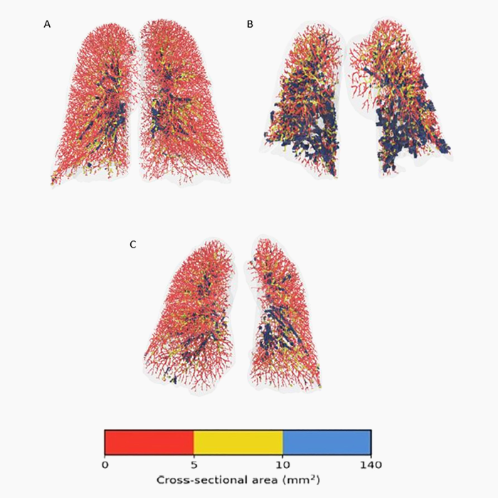 FRI – Understanding the link between pulmonary vasculature abnormalities and DCLO in COVID-19