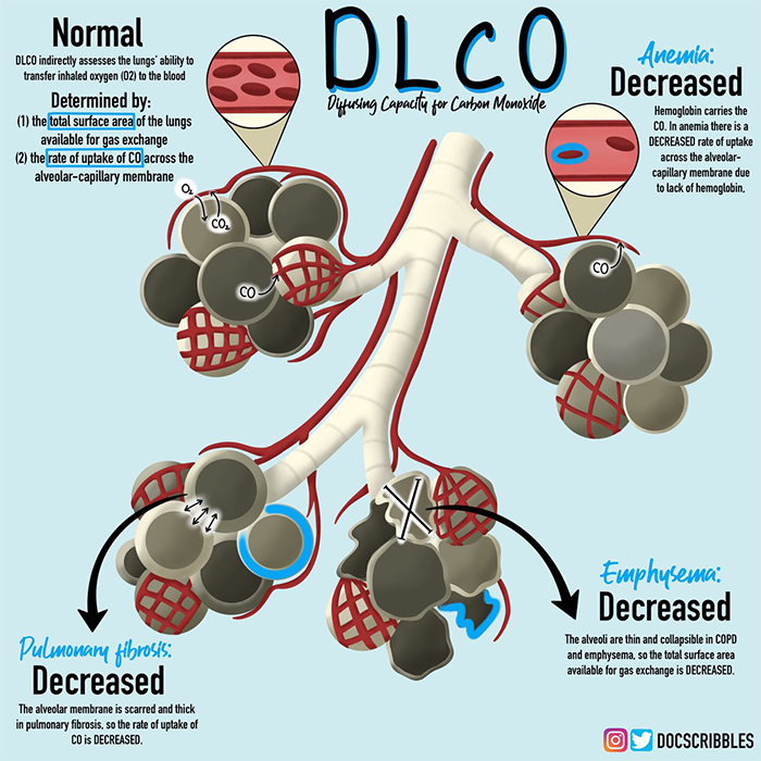 The association of abnormal pulmonary vasculature on CT scan for COVID-19 infection and decreased diffusion capacity