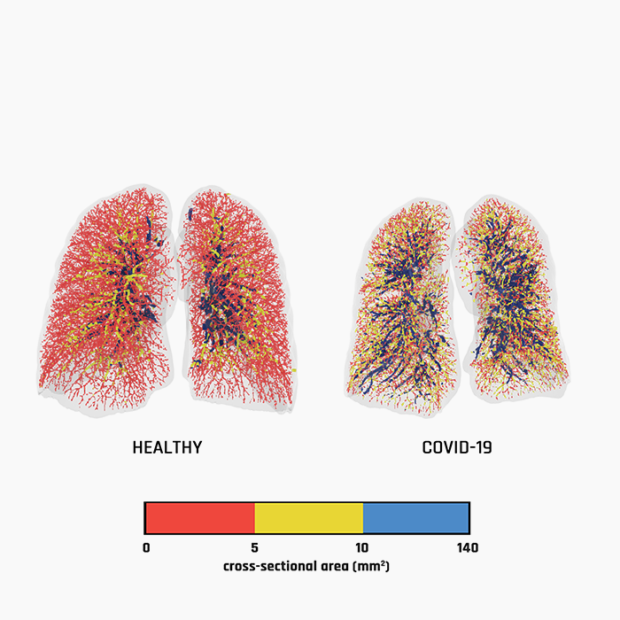 Functional Respiratory Imaging can predict the course of COVID-19